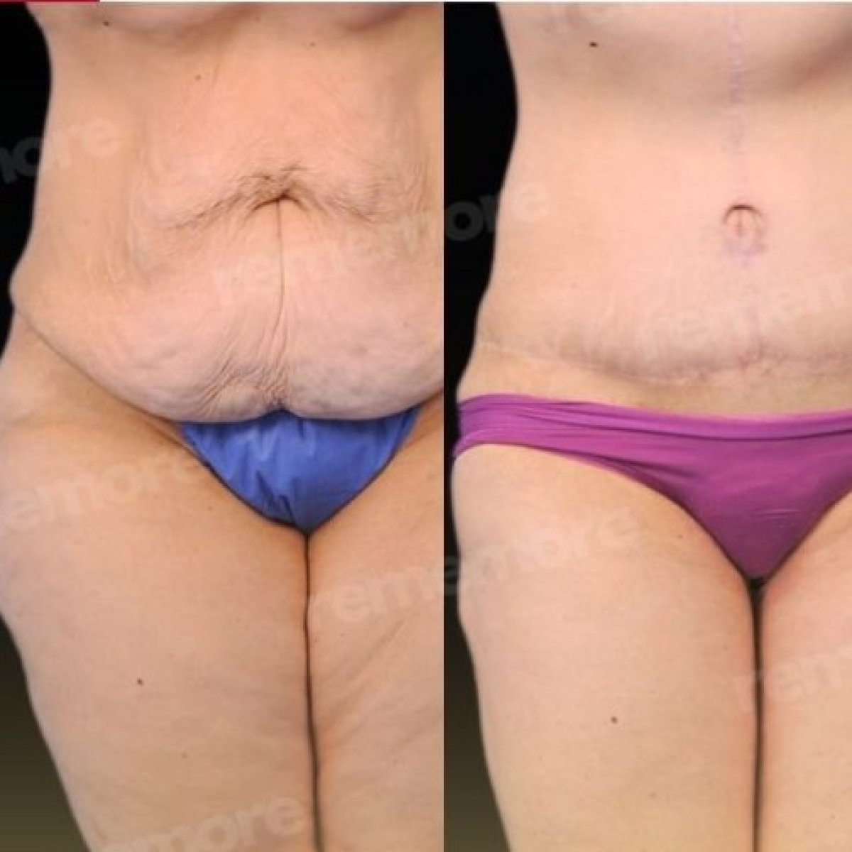 Résultats avant/après liposuccion à Memorial Bahçelievler Hospital, remodelage abdominal