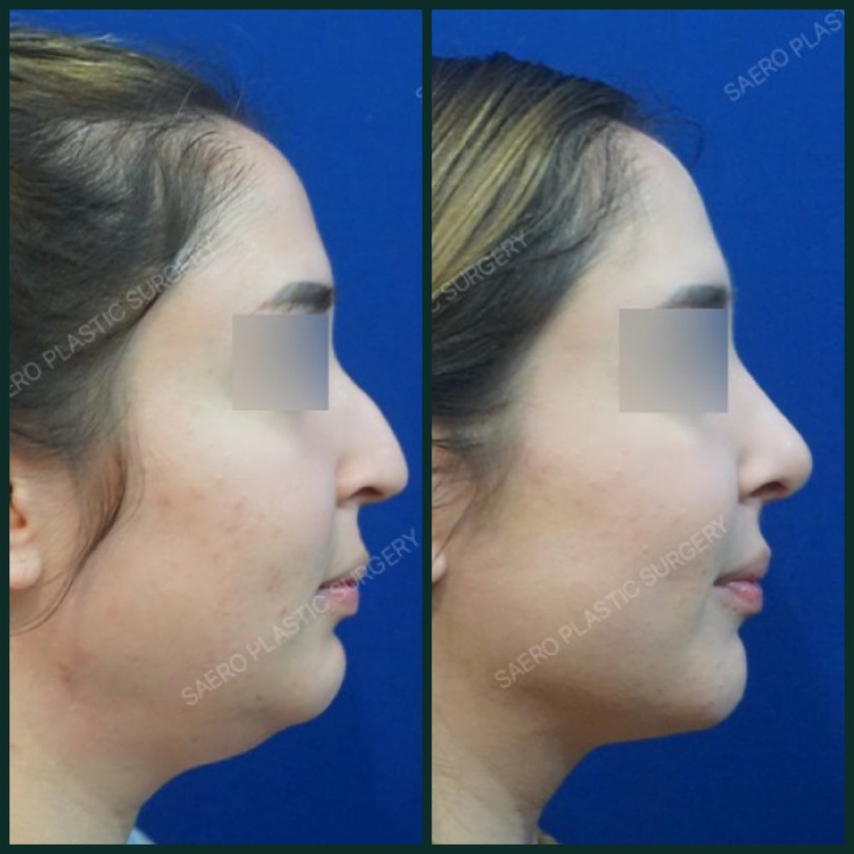 Resultados de lifting de cuello antes y después en SAERO Plastic Surgery – mandíbula definida