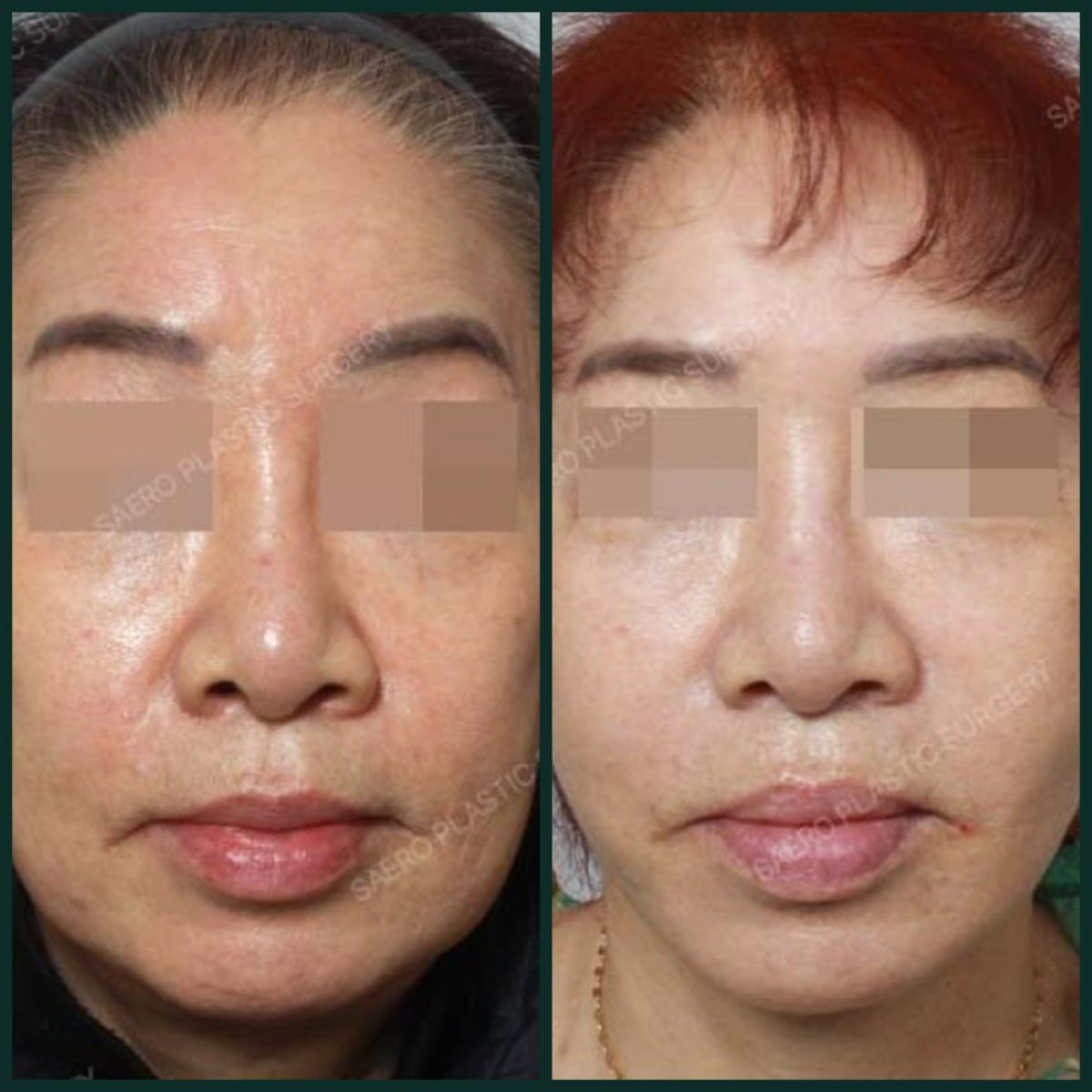 نتائج شد الوجه بالخيوط قبل وبعد في SAERO Plastic Surgery، شد بشرة الوجه