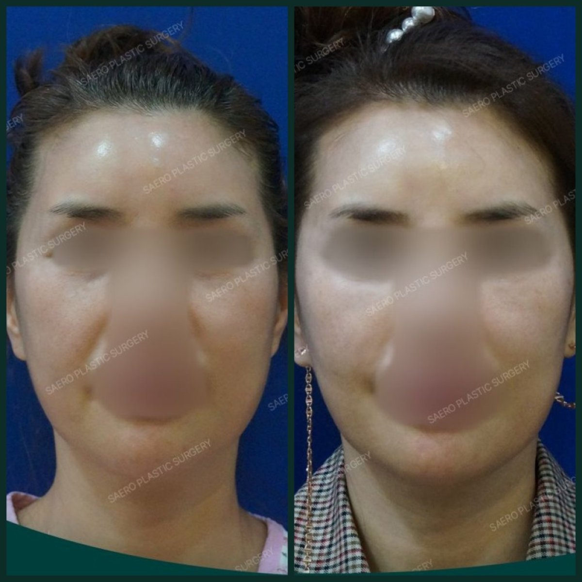 نتائج شد الوجه بالخيوط قبل وبعد في SAERO Plastic Surgery، تحسين ملامح الوجه