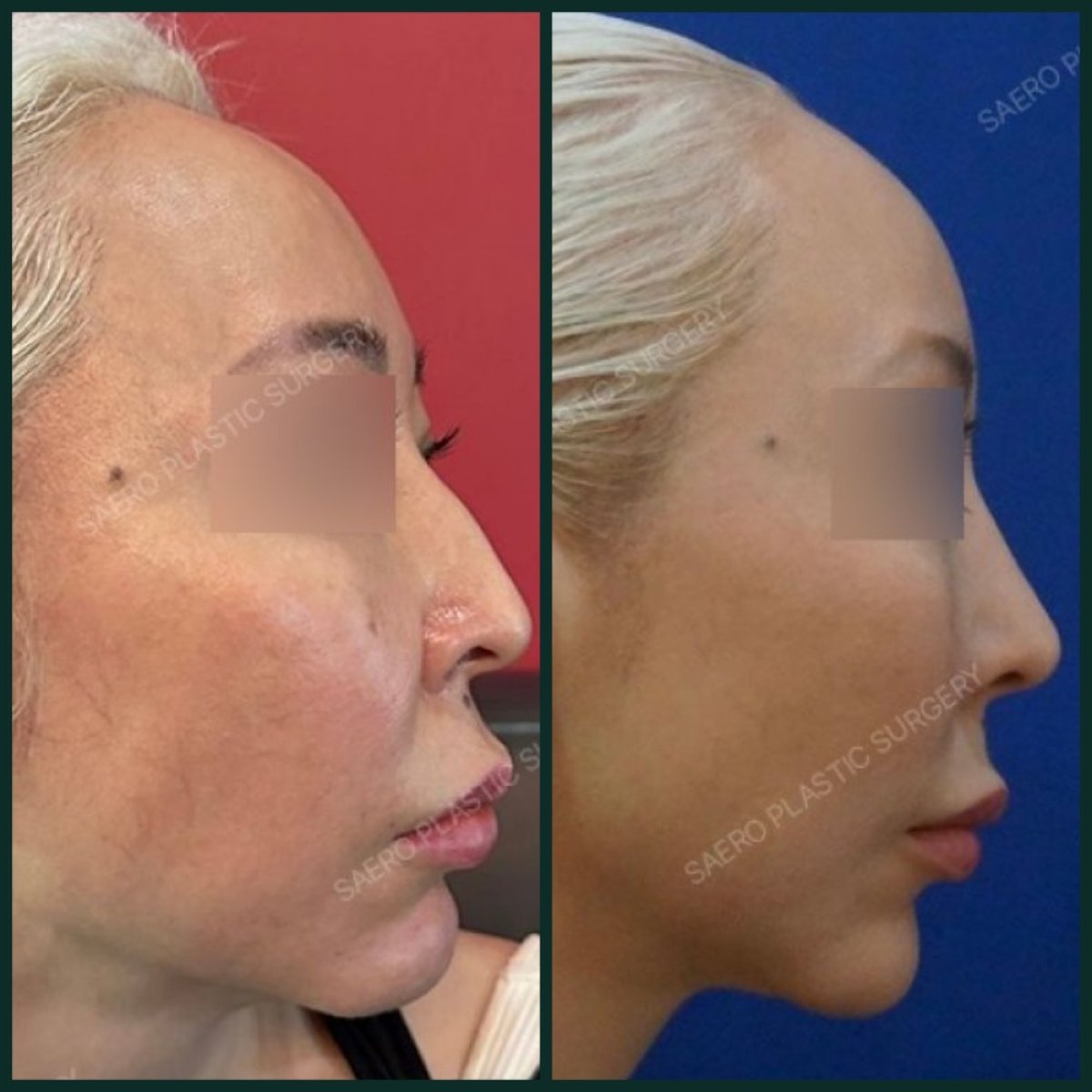 Before and after thread lifting results at SAERO Plastic Surgery – facial contour enhancement