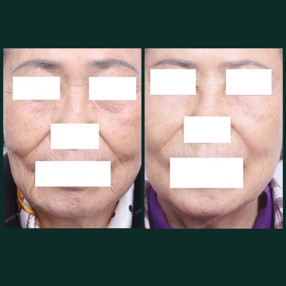 Résultats avant/après lifting par fils chez SAERO Plastic Surgery, peau du visage raffermie