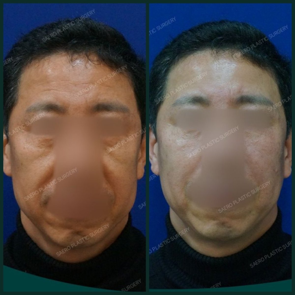 نتائج شد الوجه بالخيوط قبل وبعد في SAERO Plastic Surgery، شد بشرة الوجه