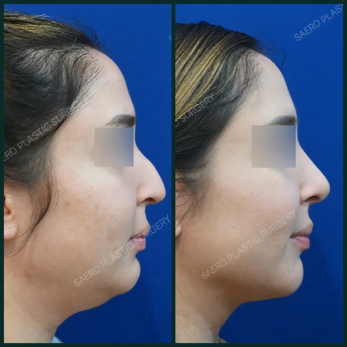 Before and after threads lifting at SAERO Plastic Surgery – improved jawline and neck contour