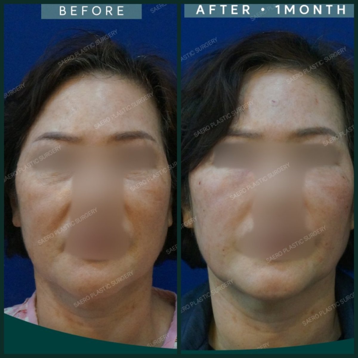نتائج شد الوجه بالخيوط قبل وبعد في SAERO Plastic Surgery مع شد واضح للبشرة