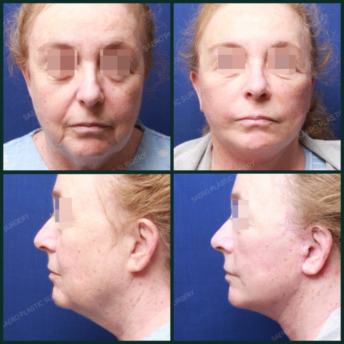 Результаты до и после нитевого лифтинга в SAERO Plastic Surgery, омоложение лица
