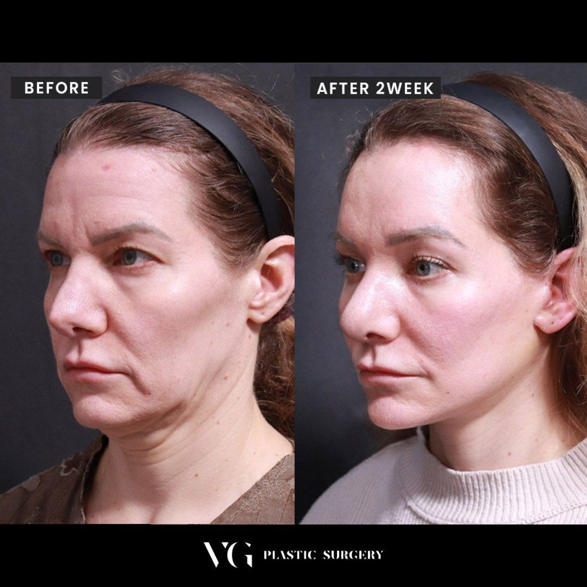 Resultados antes y después de deep plane facelift en VG Plastic Surgery, rejuvenecimiento facial