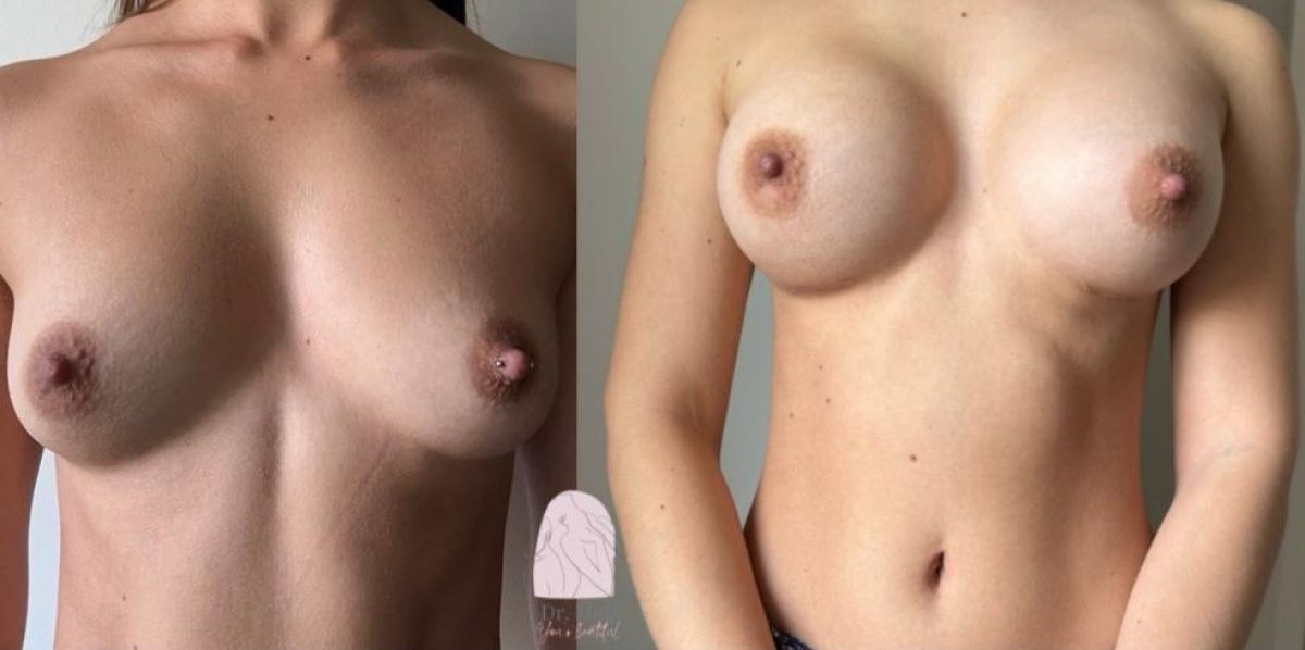 Before and after breast augmentation results at Dr. MED – enhanced breast shape and volume