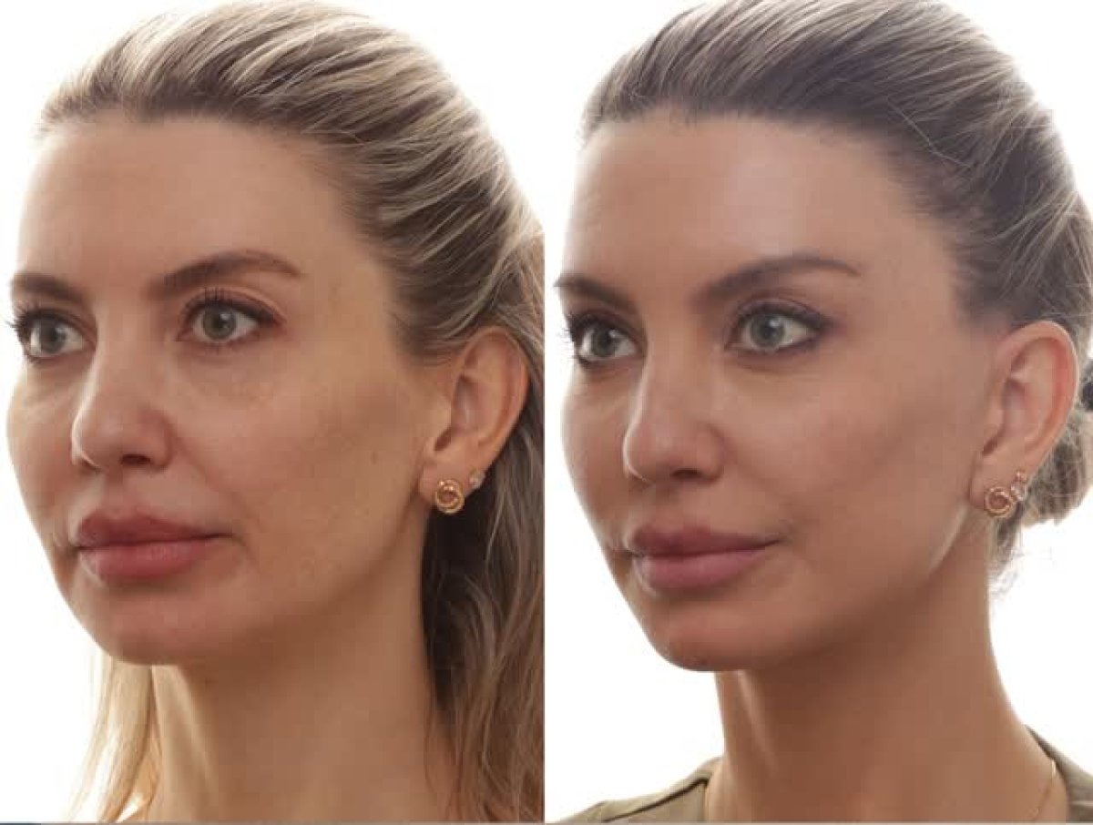 Resultados de lifting facial antes y después en Clínica Kacowicz São Paulo LTDA, rejuvenecimiento