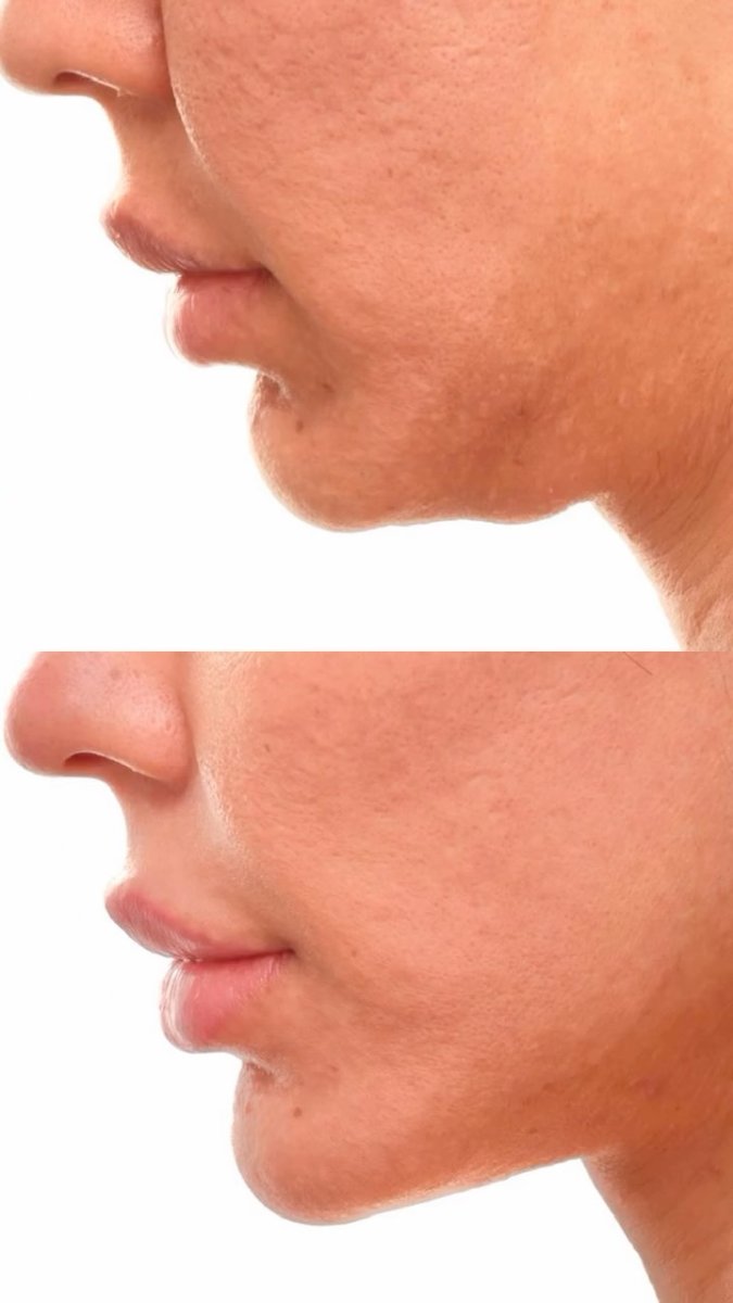 Resultados de lifting facial antes y después en Clínica Kacowicz São Paulo LTDA, contorno mejorado