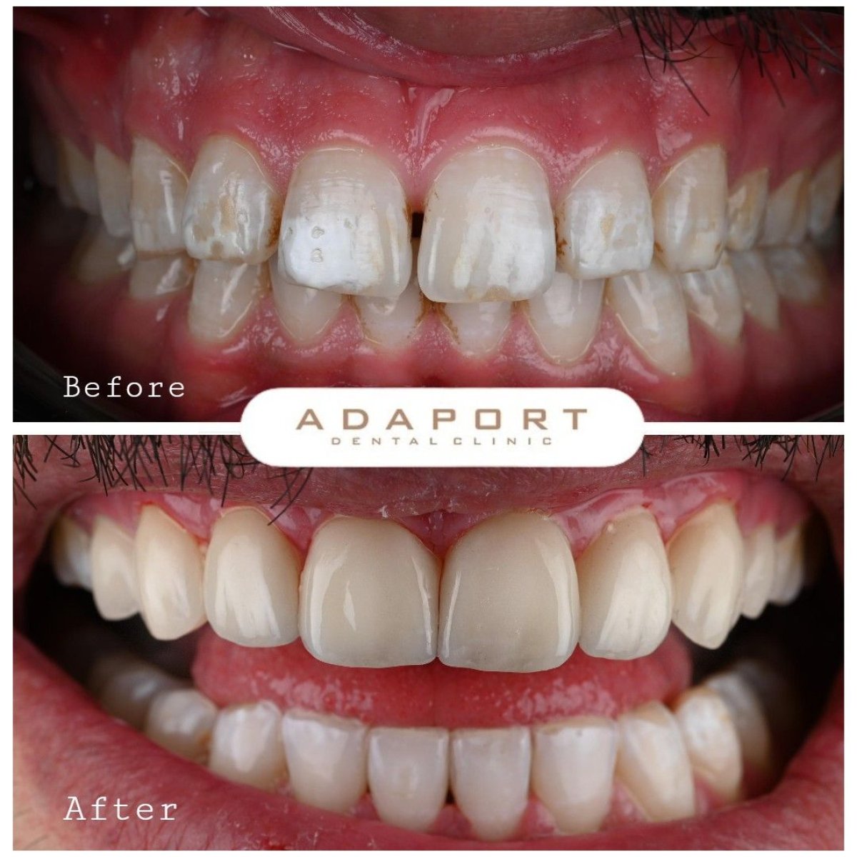 Before and after Emax veneers result at Adaport Dental Clinic, smile makeover with veneers