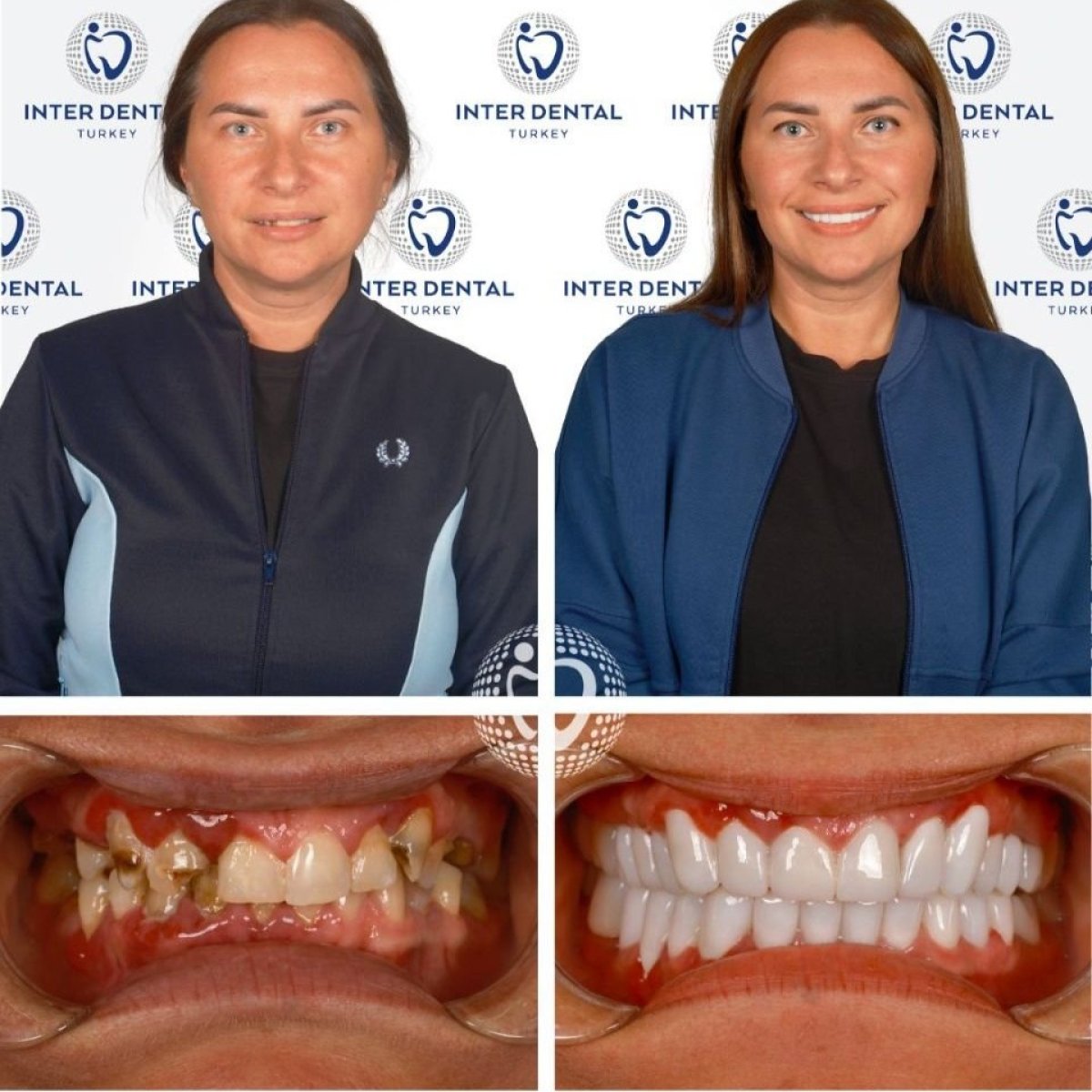 Before and after Hollywood Smile at Inter Dental Turkey – full mouth restoration results