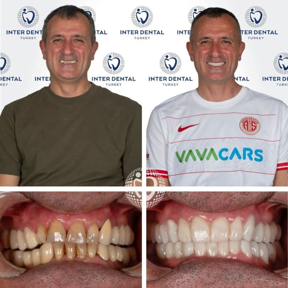 نتائج قبل وبعد ابتسامة هوليود في Inter Dental Turkey – تحول ملحوظ في الابتسامة