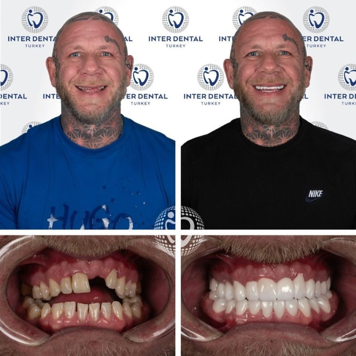Результаты до и после Hollywood Smile в Inter Dental Turkey – полное преображение улыбки
