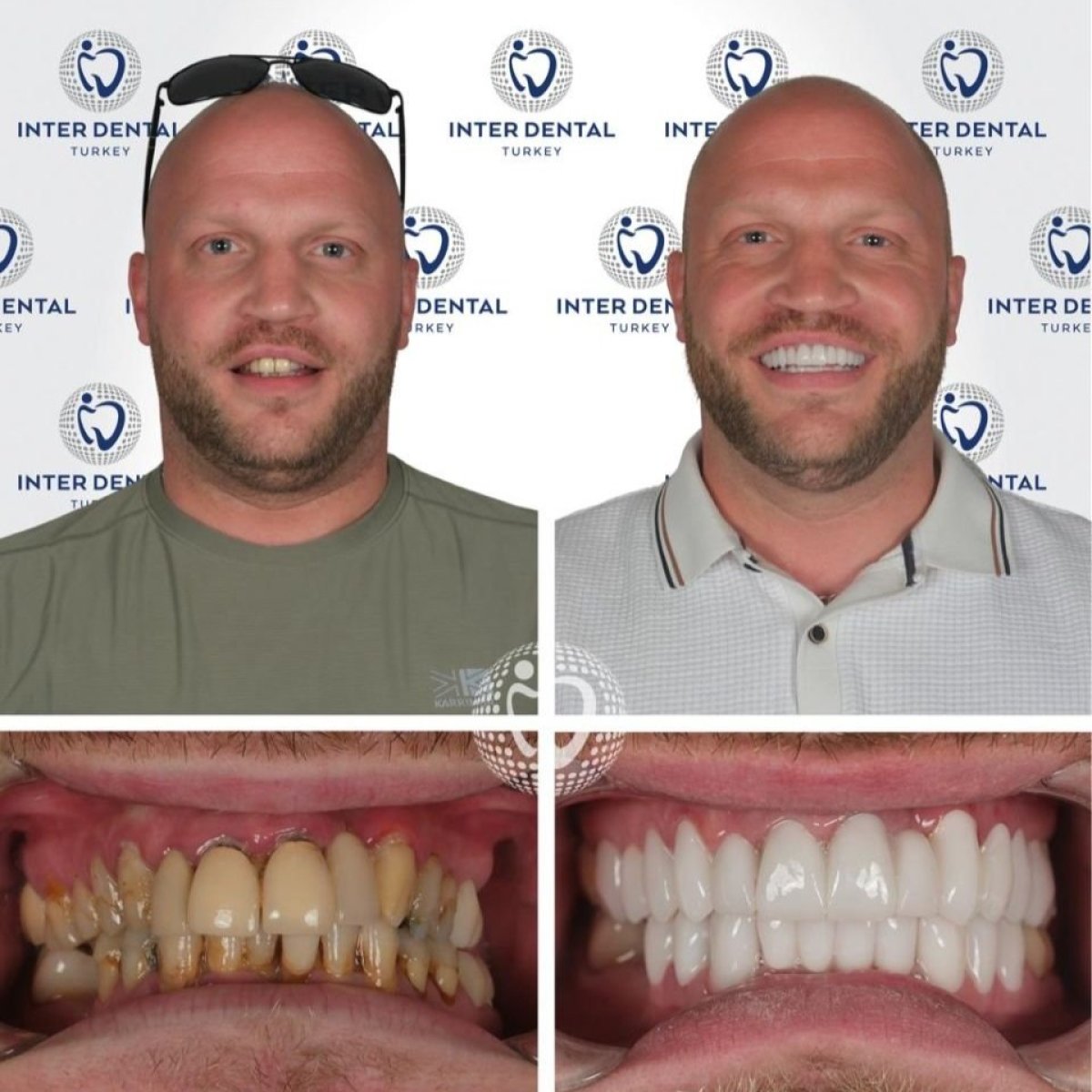 نتائج قبل وبعد ابتسامة هوليود في Inter Dental Turkey – تحول كامل للابتسامة