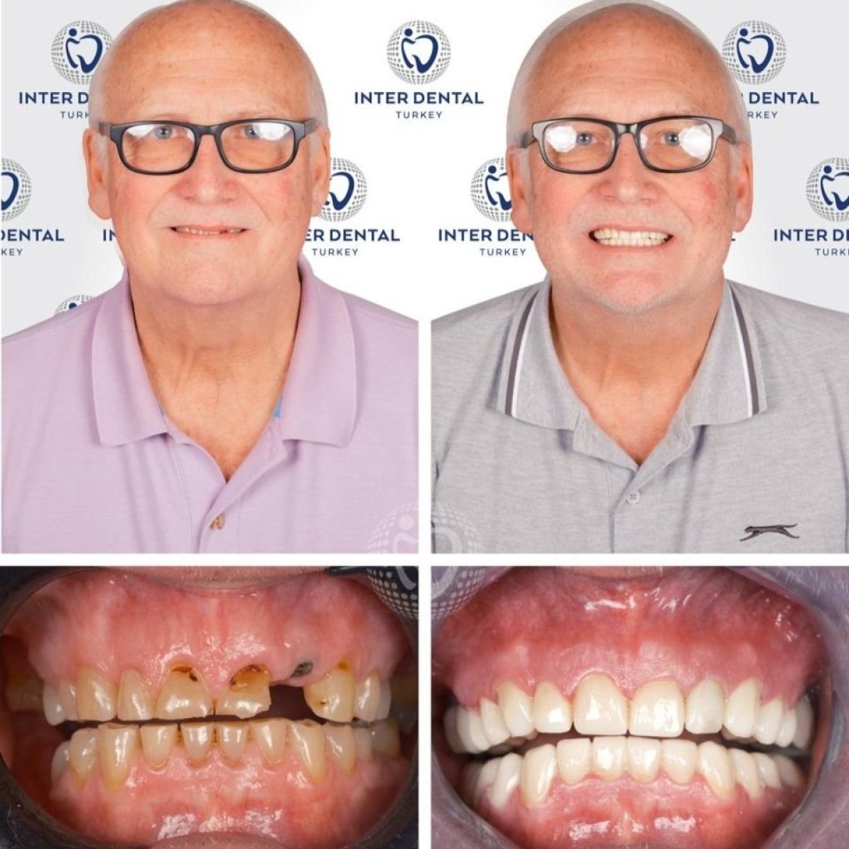 Before and after zirconia crown results at Inter Dental Turkey – smile restoration visible
