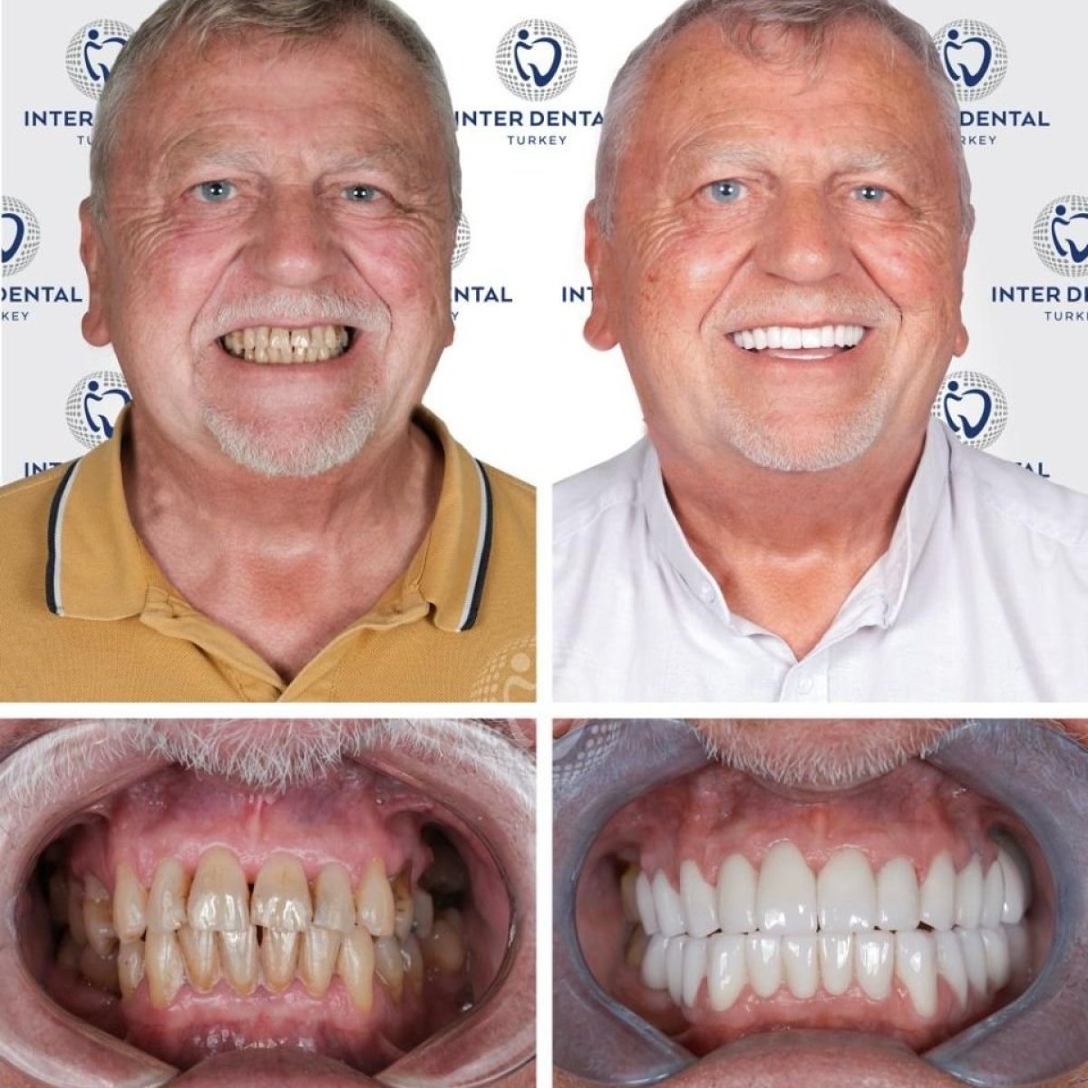 Результаты до и после установки циркониевых коронок в Inter Dental Turkey – восстановление улыбки