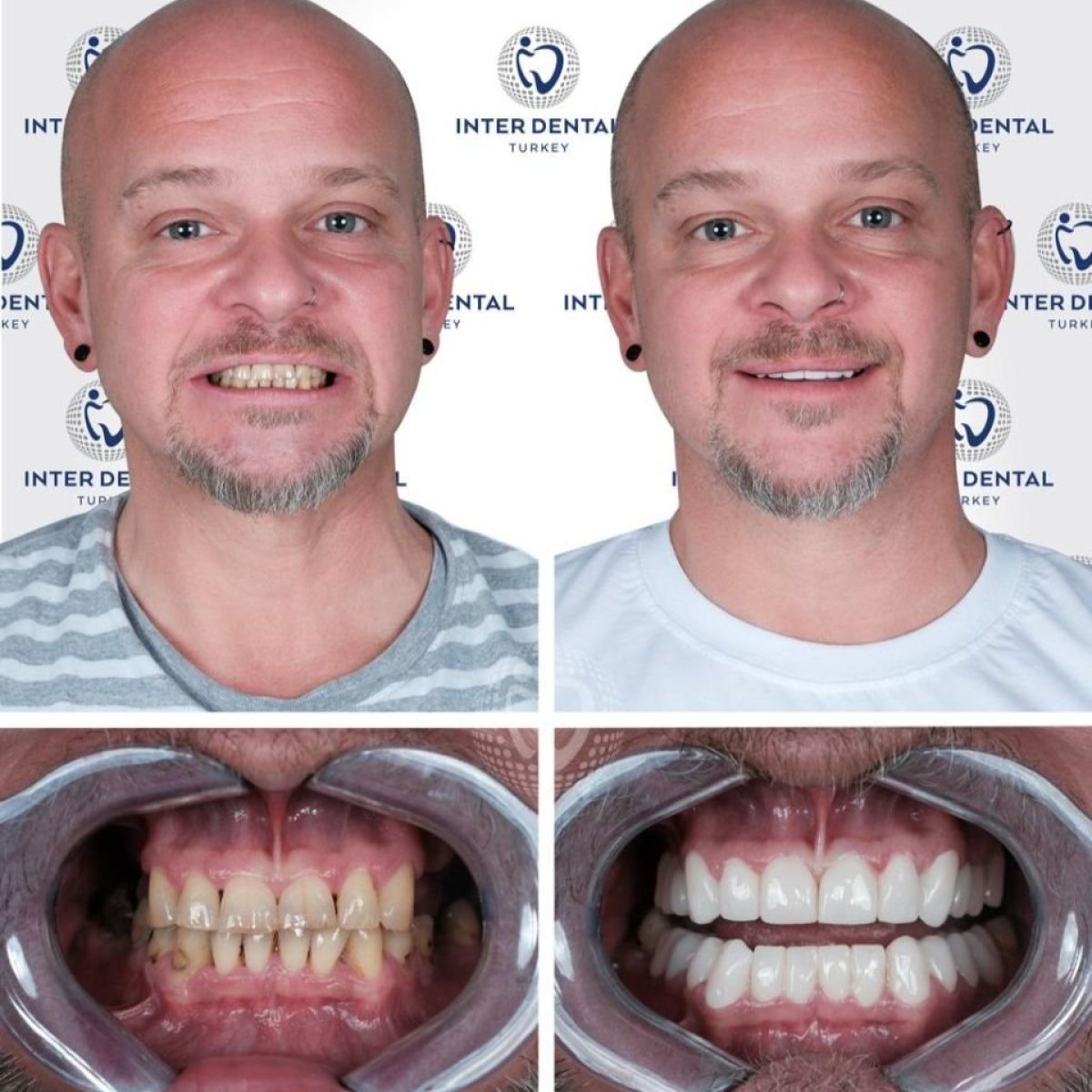 Vorher-nachher-Ergebnis Zirkonkrone bei Inter Dental Turkey – Lächeln-Transformation