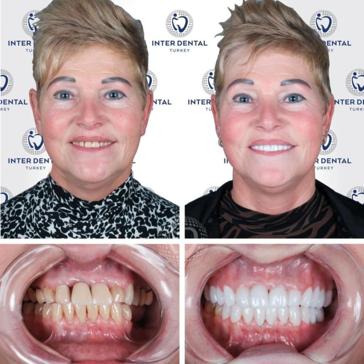 نتائج قبل وبعد تركيب تيجان الزركونيا في Inter Dental Turkey – تحول الابتسامة