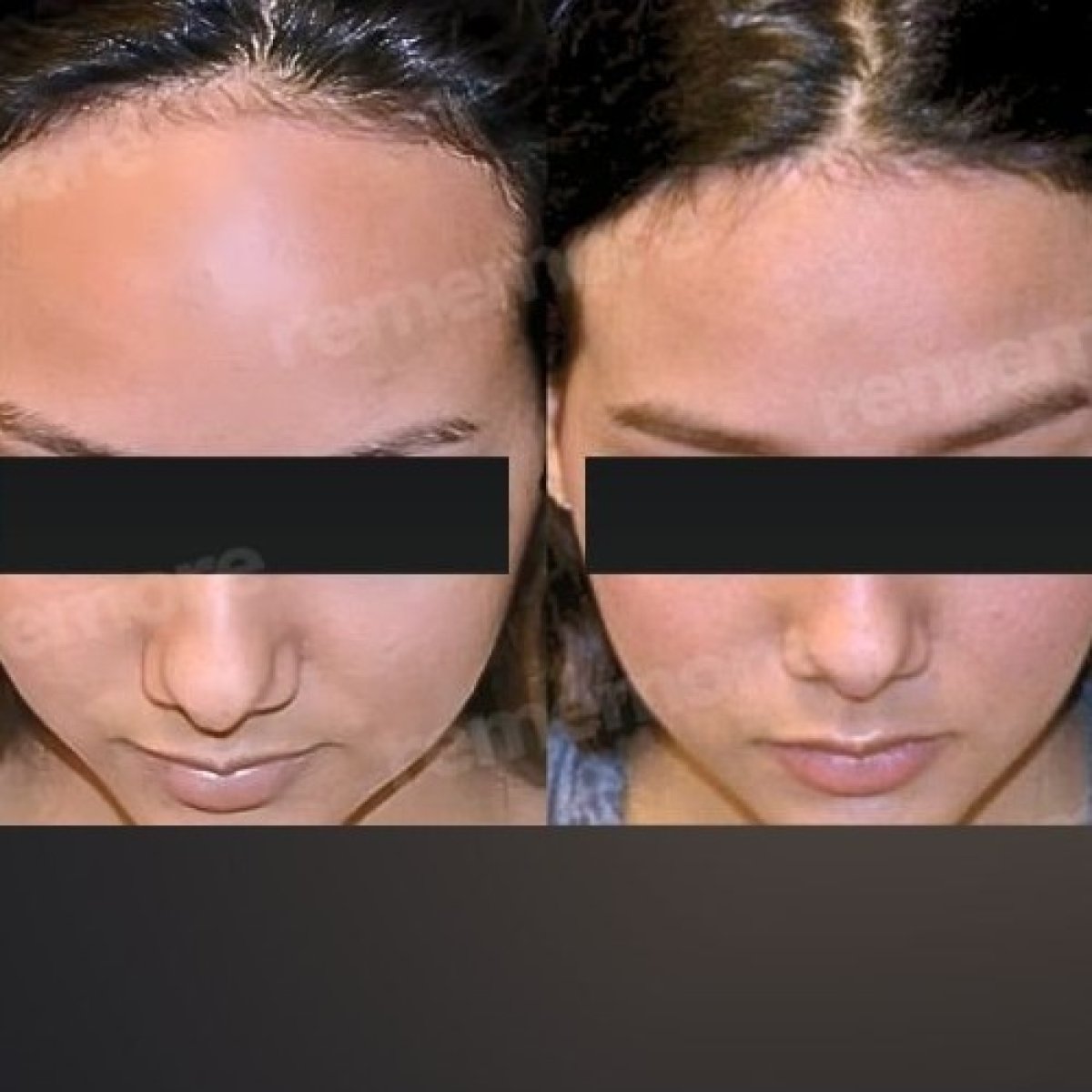 Before and after forehead contouring results at Memorial Bahçelievler Hospital, smoother forehead