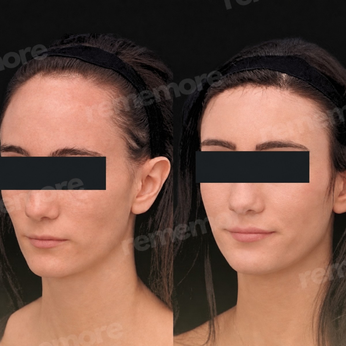 Before and after forehead contouring results at Memorial Bahçelievler Hospital, facial harmony