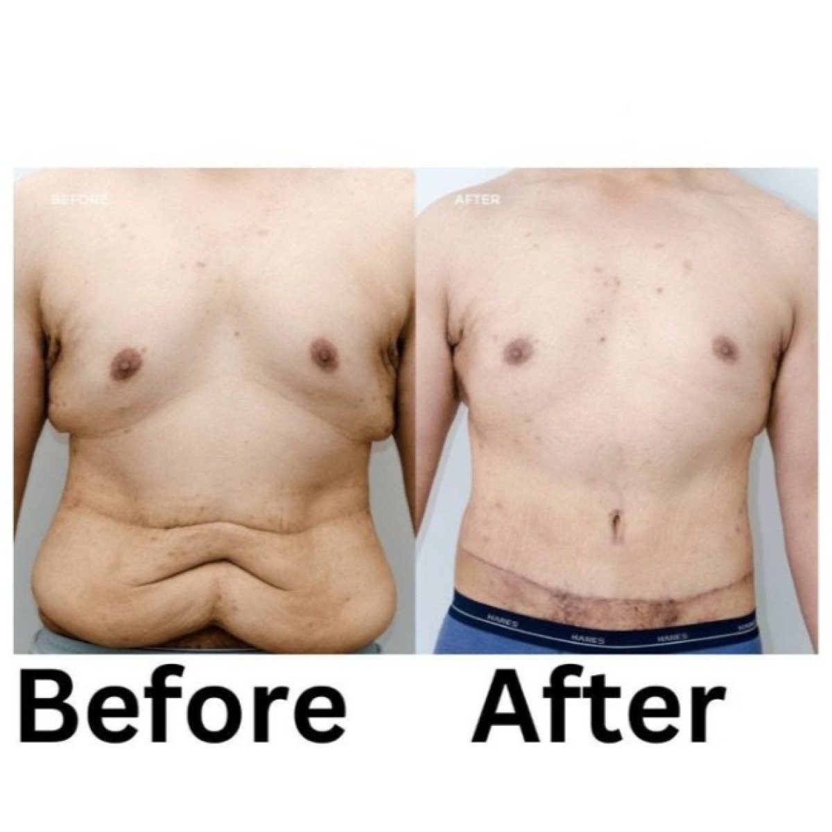 Before and after tummy tuck and liposuction results at ID Clinic Bangkok, improved abdomen contour