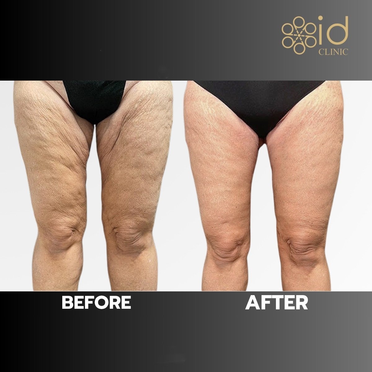 Before and after thigh lift results at ID Clinic Bangkok, improved leg contour and skin tightness