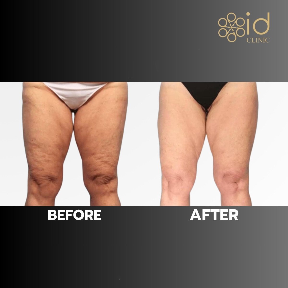 Before and after thigh lift results at ID Clinic Bangkok – smoother, firmer thigh contour