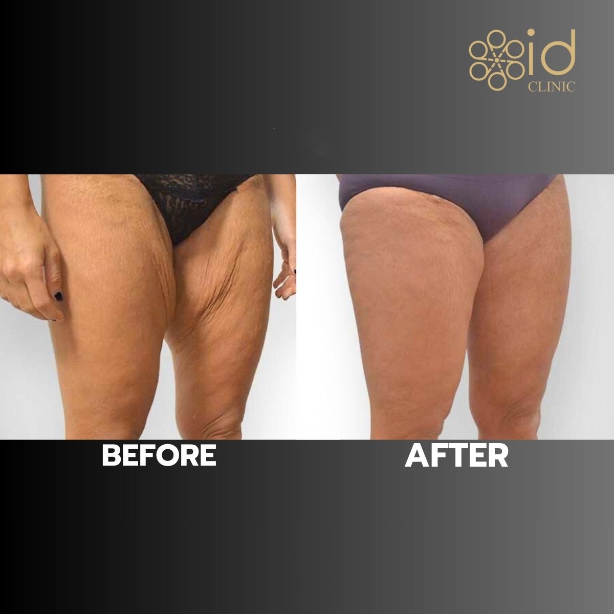 Before and after thigh lift results at ID Clinic Bangkok, improved thigh contour and skin tightness