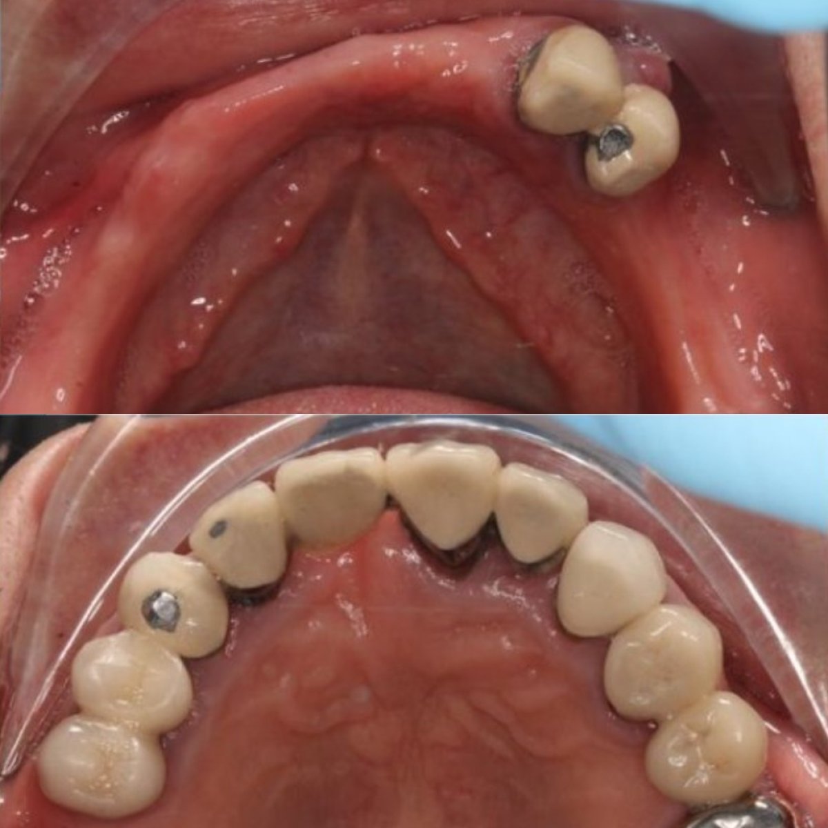 Résultats avant et après implants dentaires à Xiamen Humanity Hospital, restauration des dents supérieures