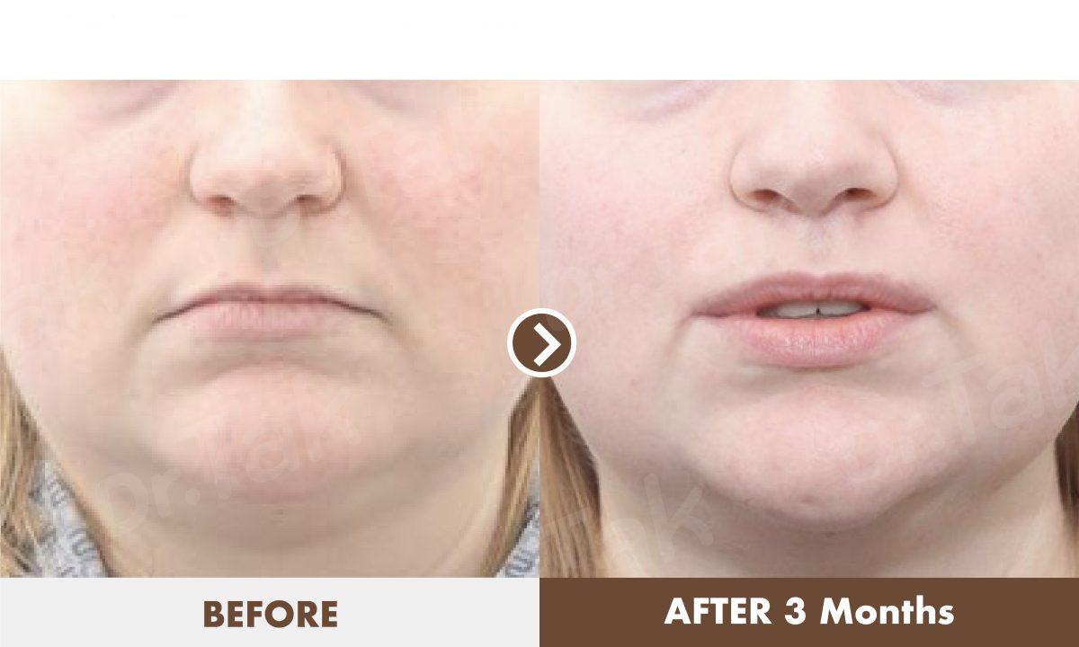 Before and after lip lift results at Dr. Tak Plastic Surgery, improved lip contour after 3 months