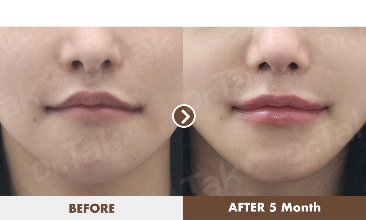 Результати до і після ліпліфтингу в Dr. Tak Plastic Surgery, покращений контур губ через 5 місяців