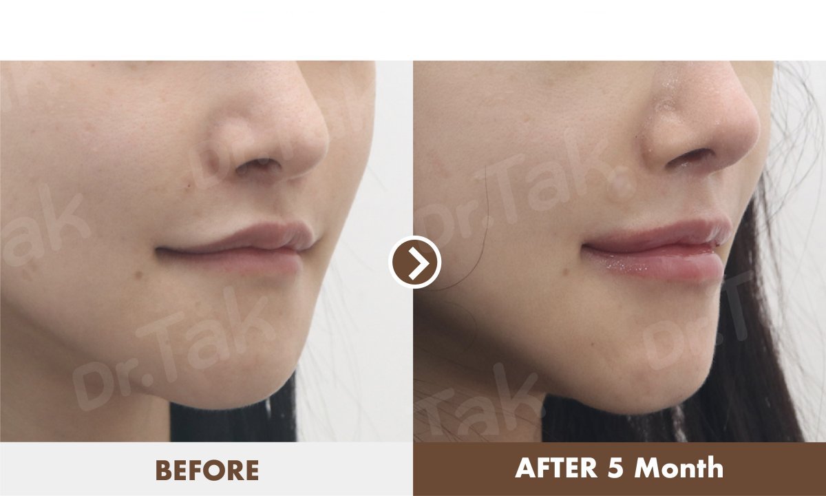 Before and after lip lift results at Dr. Tak Plastic Surgery, enhanced lip contour after 5 months