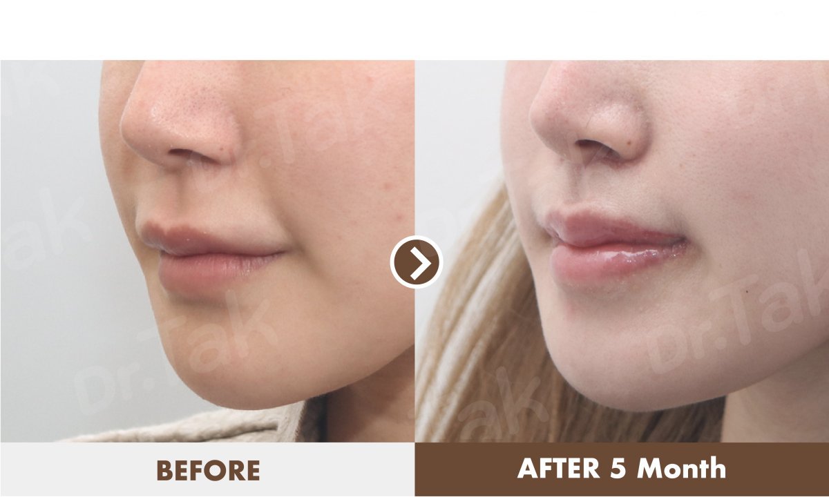 Resultados de lifting de labios antes y después en Dr. Tak Plastic Surgery, contorno mejorado
