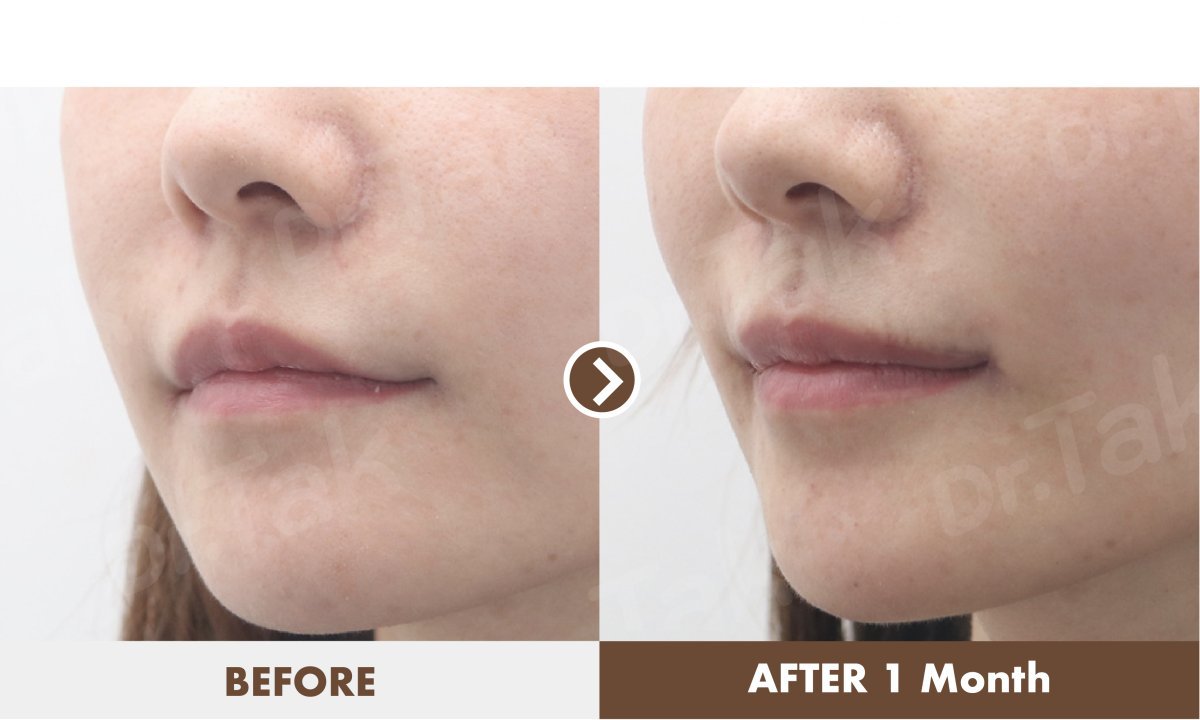 نتائج قبل وبعد رفع الشفاه في عيادة Dr. Tak Plastic Surgery، تحسين شكل الشفاه