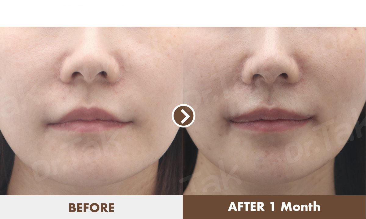 Результат ліпліфта до і через 1 місяць у Dr. Tak Plastic Surgery, покращений контур губ