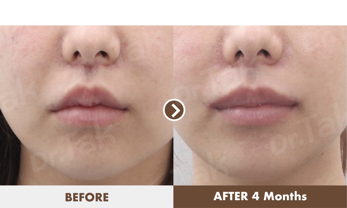 Resultados de lifting de labios antes y después en Dr. Tak Plastic Surgery tras 4 meses