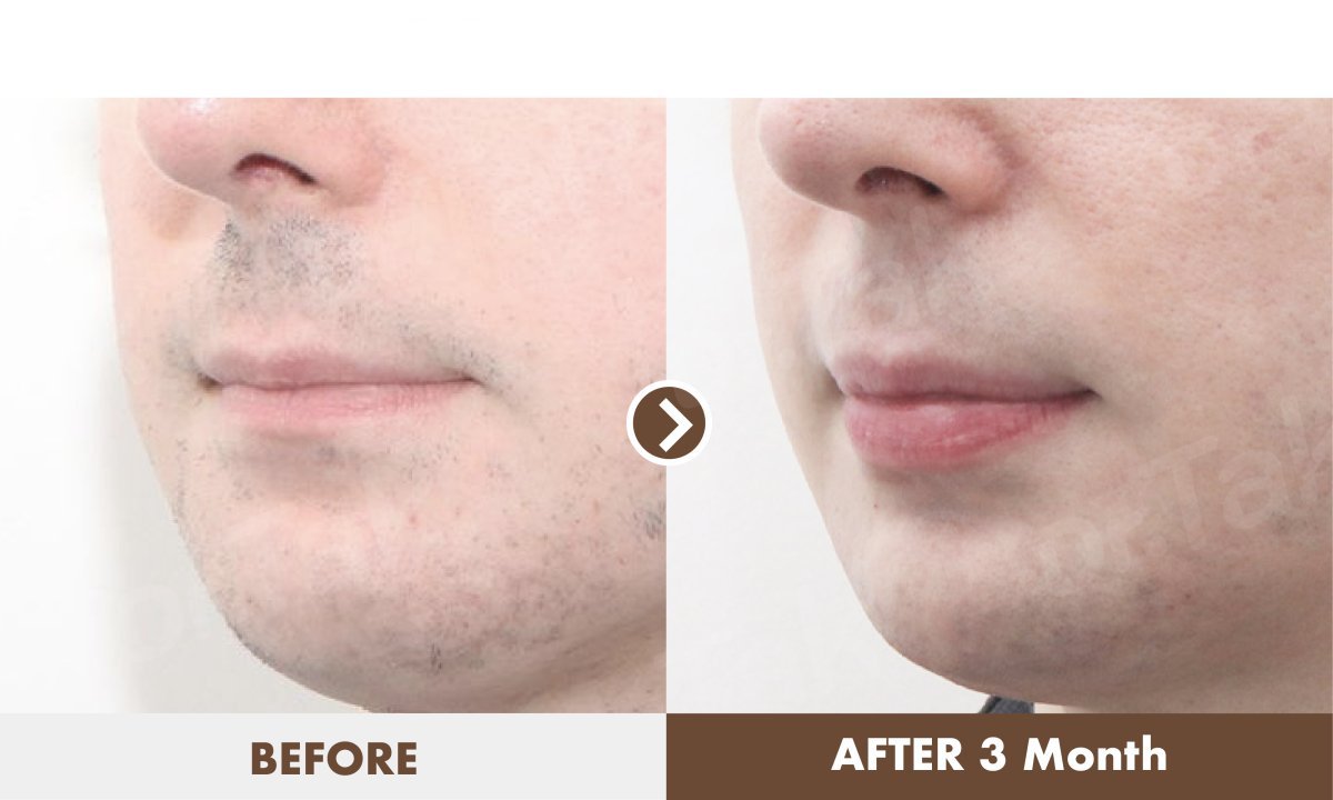 Resultados de lip lift antes y después en Dr. Tak Plastic Surgery – contorno de labios mejorado en 3 meses