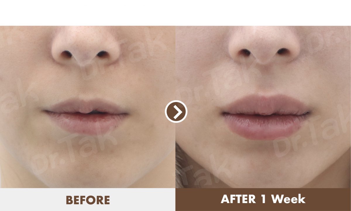 Resultados de lip lift antes y después en Dr. Tak Plastic Surgery – labios más llenos tras 1 semana
