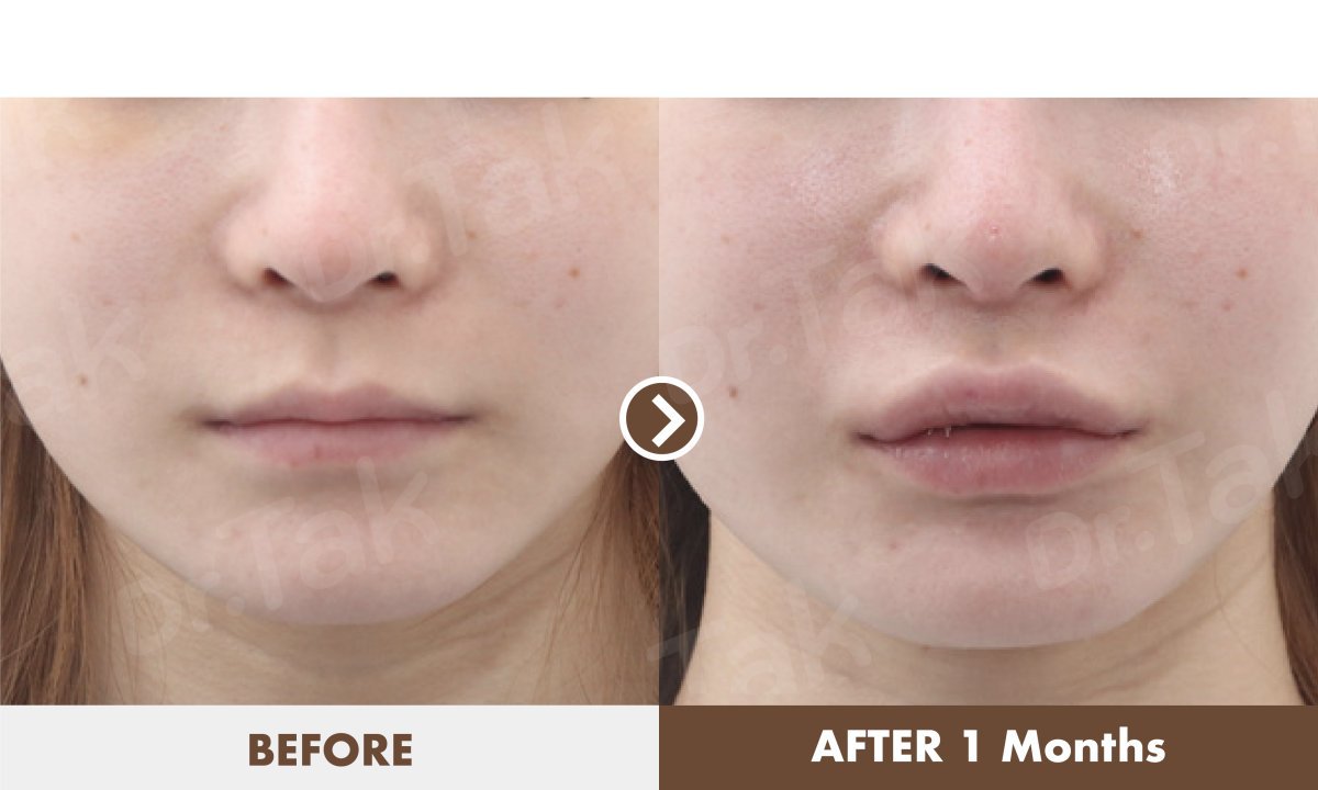 Resultados antes y después de lip lift en Dr. Tak Plastic Surgery, realce visible del labio superior
