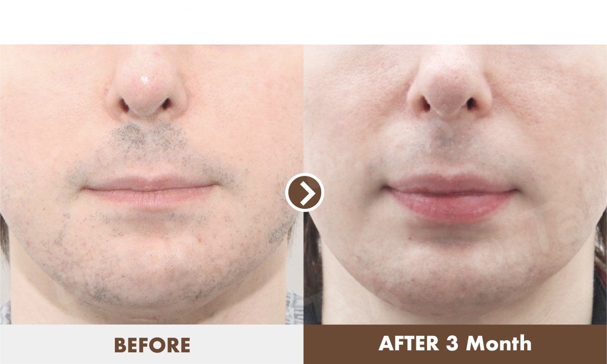 Lip-Lift Vorher-Nachher-Ergebnisse bei Dr. Tak Plastic Surgery, verbesserte Lippenkontur