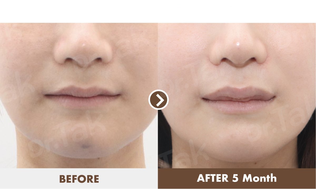 Resultados de lifting de labios antes y después en Dr. Tak Plastic Surgery, mejora visible