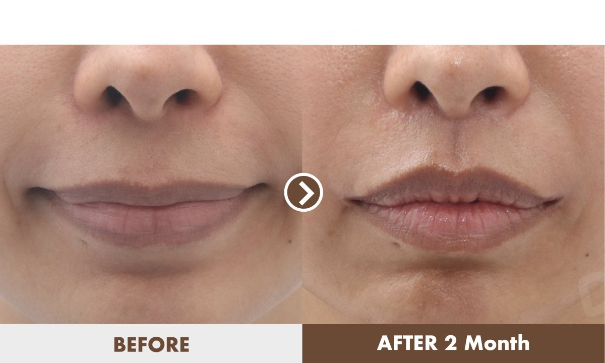 Before and after lip lift results at Dr. Tak Plastic Surgery, visible lip enhancement after 2 months