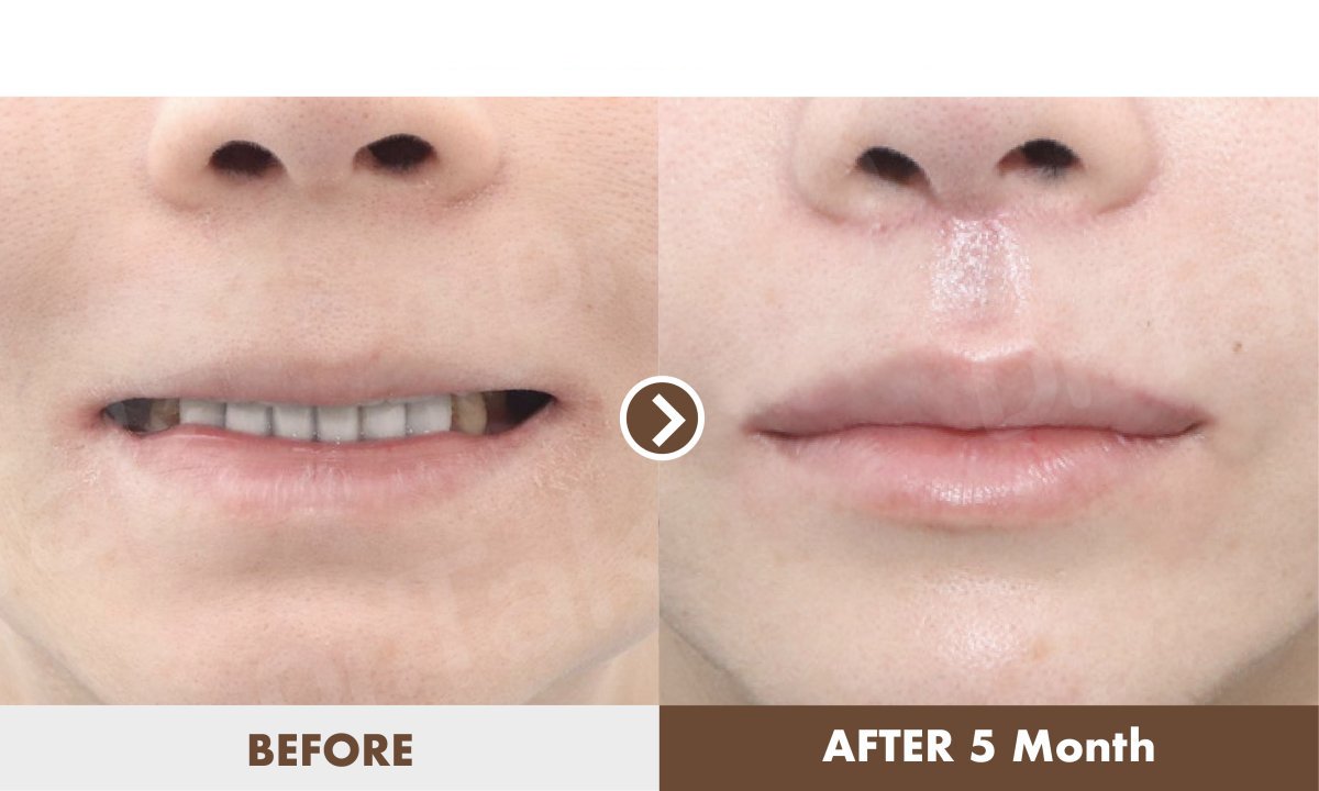 Lip lift before and after results at Dr. Tak Plastic Surgery – improved lip contour after 5 months