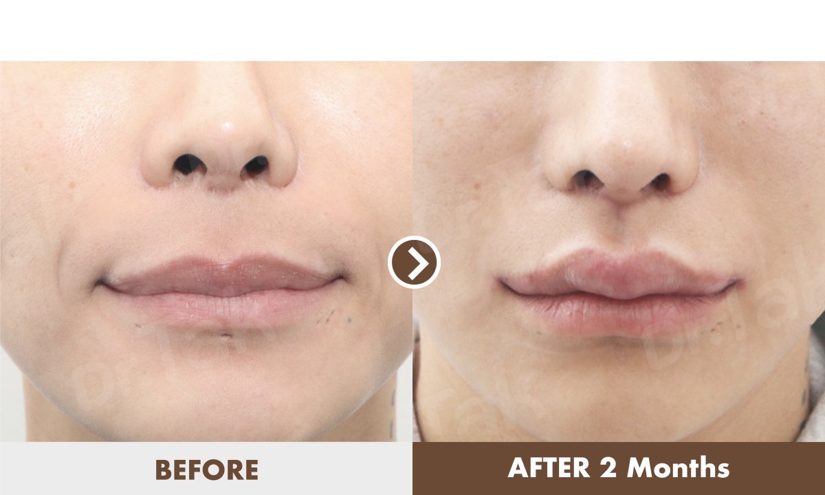 Результати до і після ліп-ліфтингу в Dr. Tak Plastic Surgery, покращення губ через 2 місяці