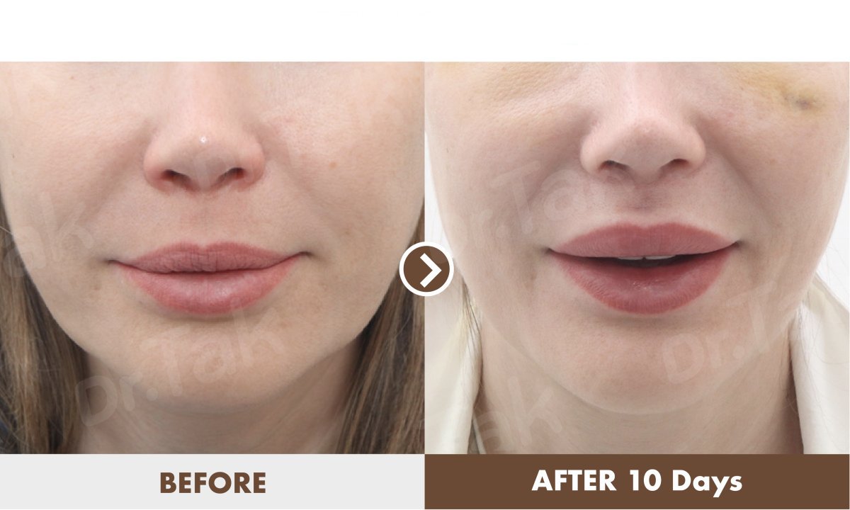 Resultados de lifting de labios antes y después en Dr. Tak Plastic Surgery, mejora visible tras 10 días