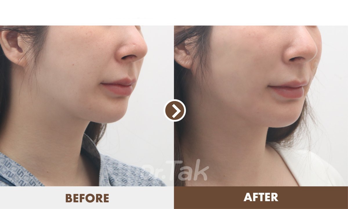 نتائج شد الوجه قبل وبعد في عيادة Dr. Tak Plastic Surgery – تحسين ملامح الوجه