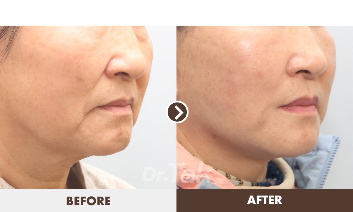 Facelift before and after results at Dr. Tak Plastic Surgery – visible facial rejuvenation
