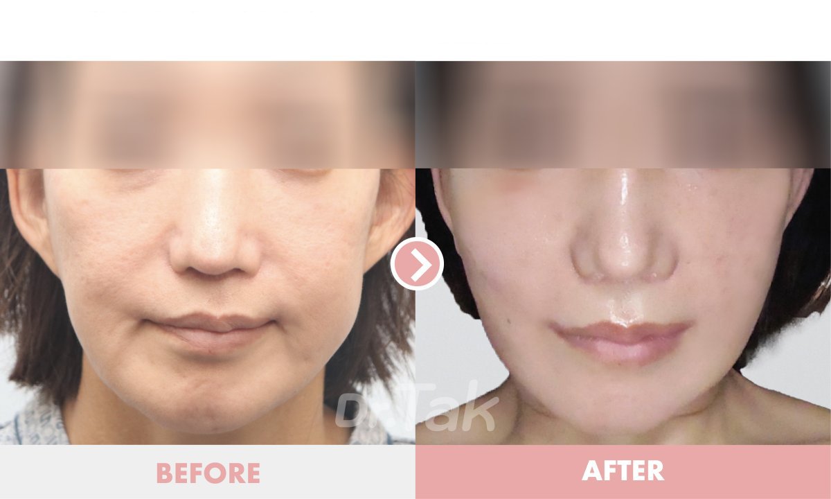 نتائج شد الوجه قبل وبعد في عيادة Dr. Tak Plastic Surgery – تجديد شباب الوجه