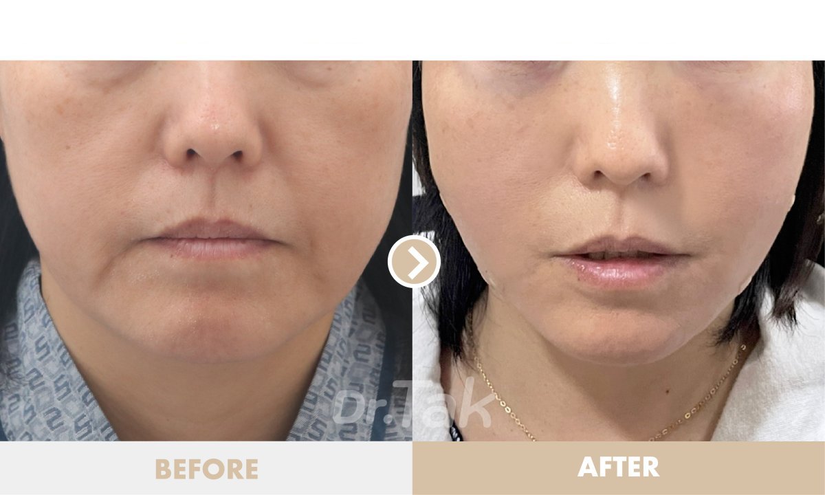Facelift before and after results at Dr. Tak Plastic Surgery – visible facial rejuvenation